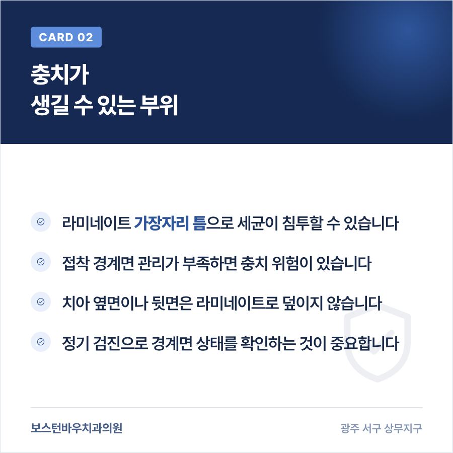 라미네이트 경계면 충치 위험 설명 이미지