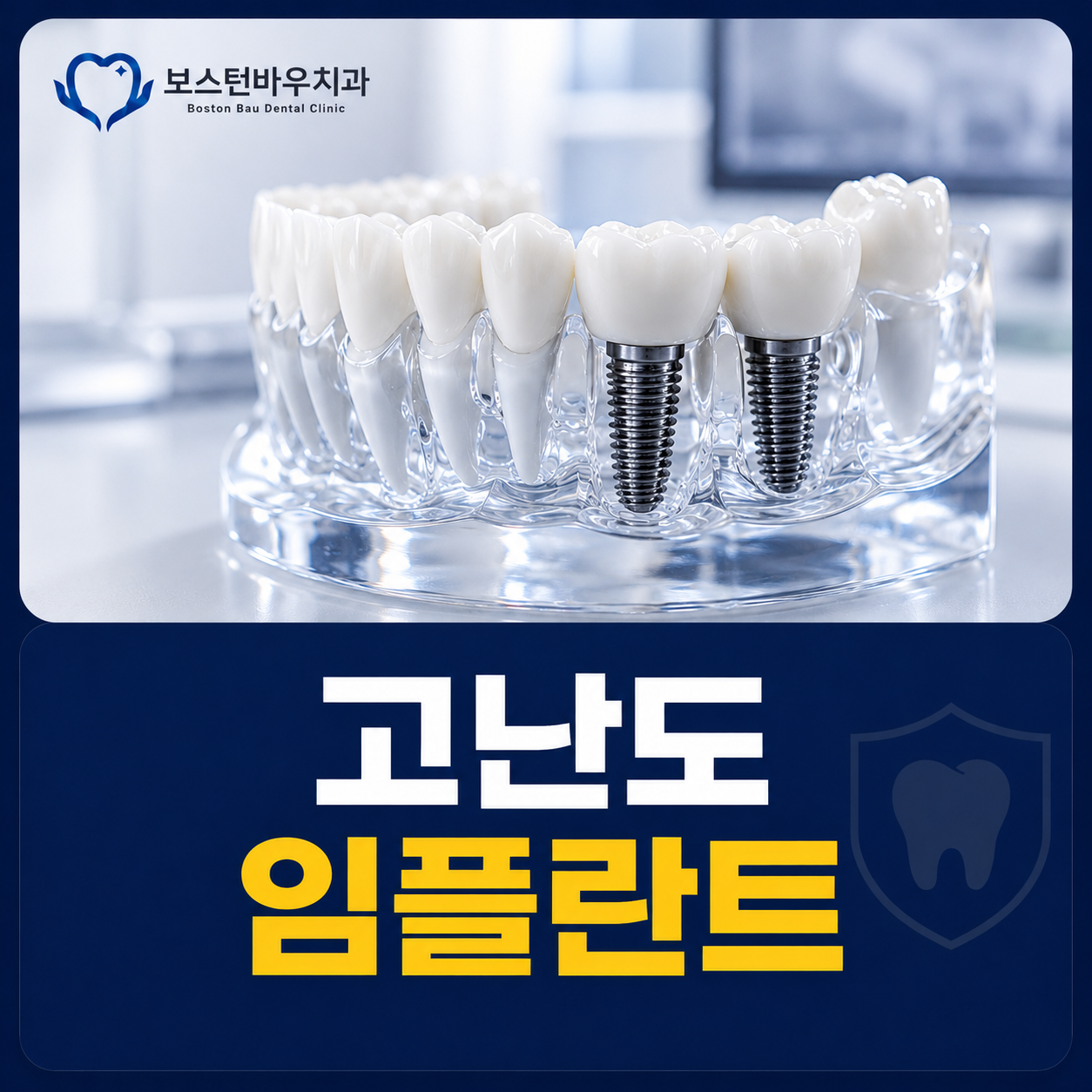 광주 서구 상무지구 고난도 임플란트 뼈이식 인플란트
